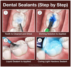 Dental Sealants (Step by Step)