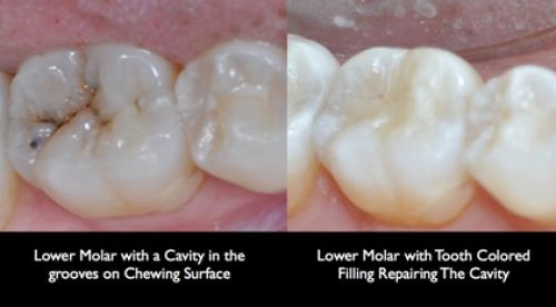 composite tooth colored filling